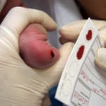 Diagnostic néonatal d'une aminoacidopathie